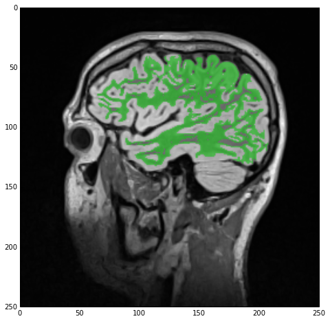 Label overlay showing the results of the white-matters initial segmentation over the denoised MR image.