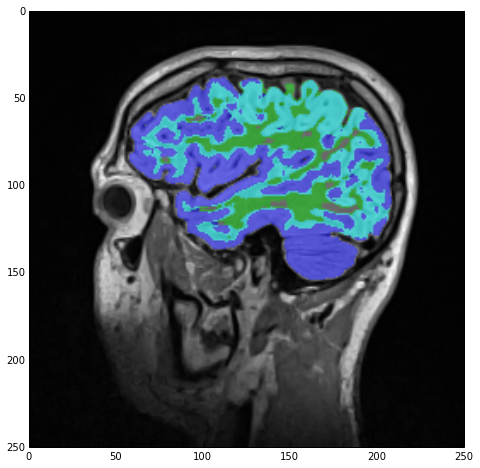 Label overlay showing both white and gray matter.
