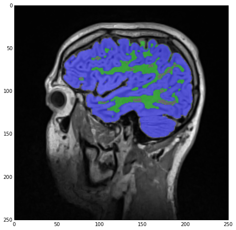 Label overlay showing both white and gray matter after assigning the common regions to gray matter.